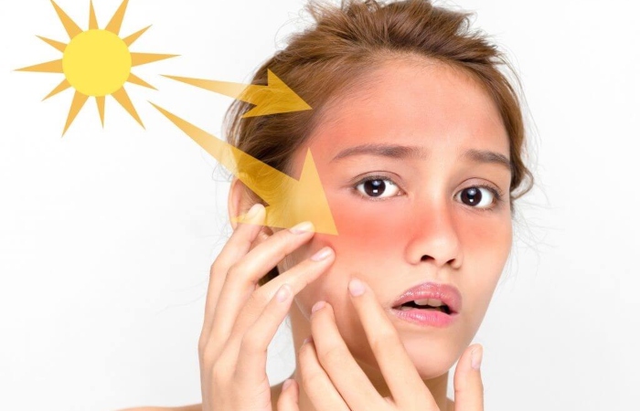 [DHC] Bật mí 10 cách chữa da mặt bị cháy nắng hiệu quả cực nhanh tại nhà