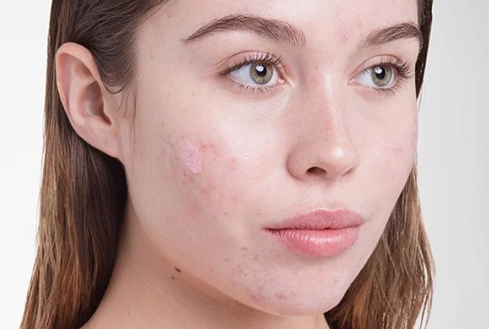 7 cách điều trị da mặt bị ngứa và sần sùi hiệu quả an toàn tại nhà