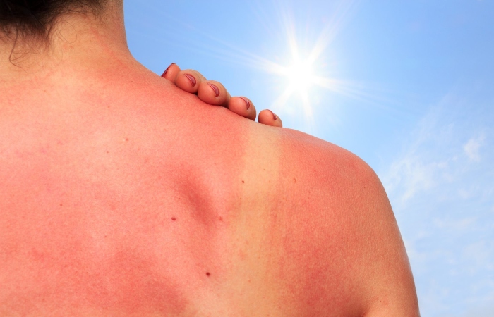 [DHC] Top 5+ cách làm trắng da mặt khi bị cháy nắng hiệu quả tại nhà