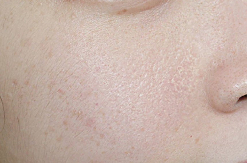 Top 10 loại mặt nạ cho da khô sần sùi dưỡng da căng mướt tự nhiên