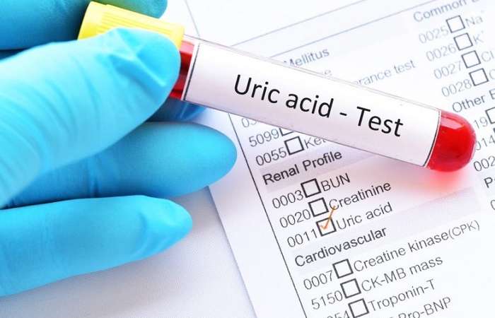 A xít u ric là gì? Nguyên nhân tăng uric acid máu cao 2021